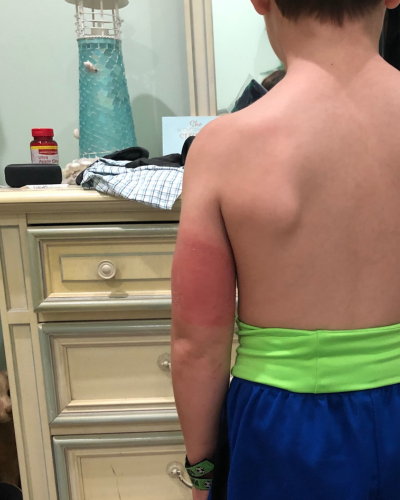 Top Tips to Stop Skin Irritation For Type 1 Diabetic Kids - Mom Of A Type 1